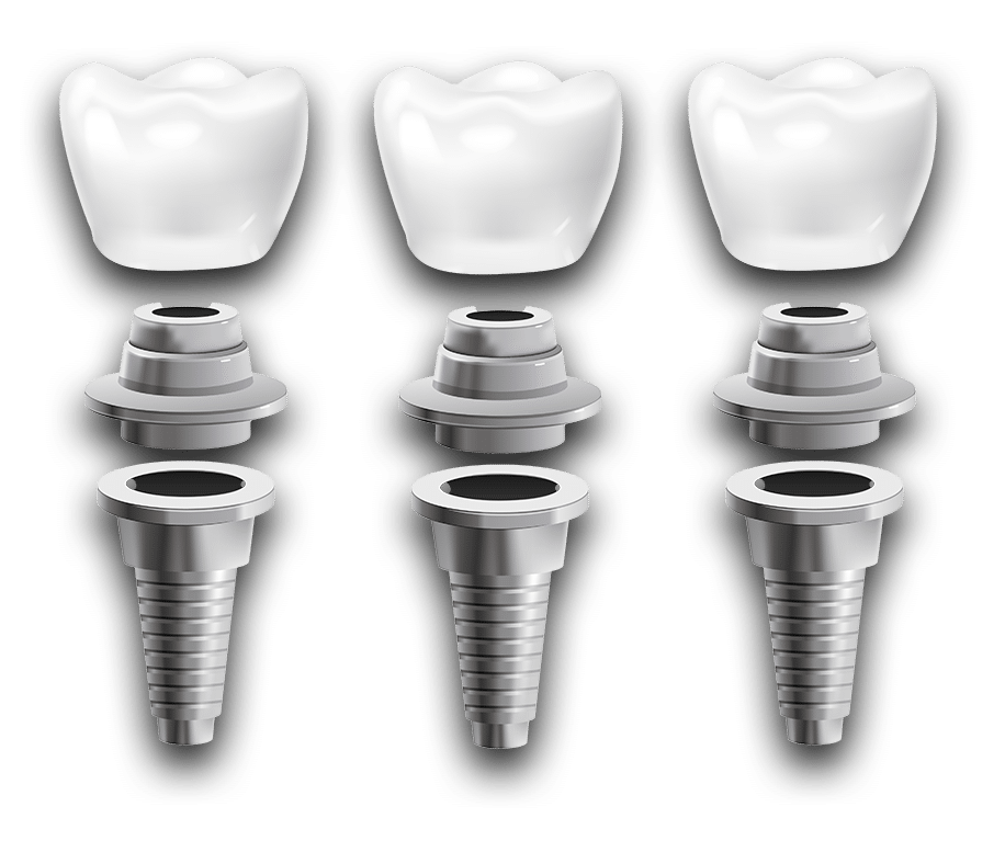 dental implant diagram