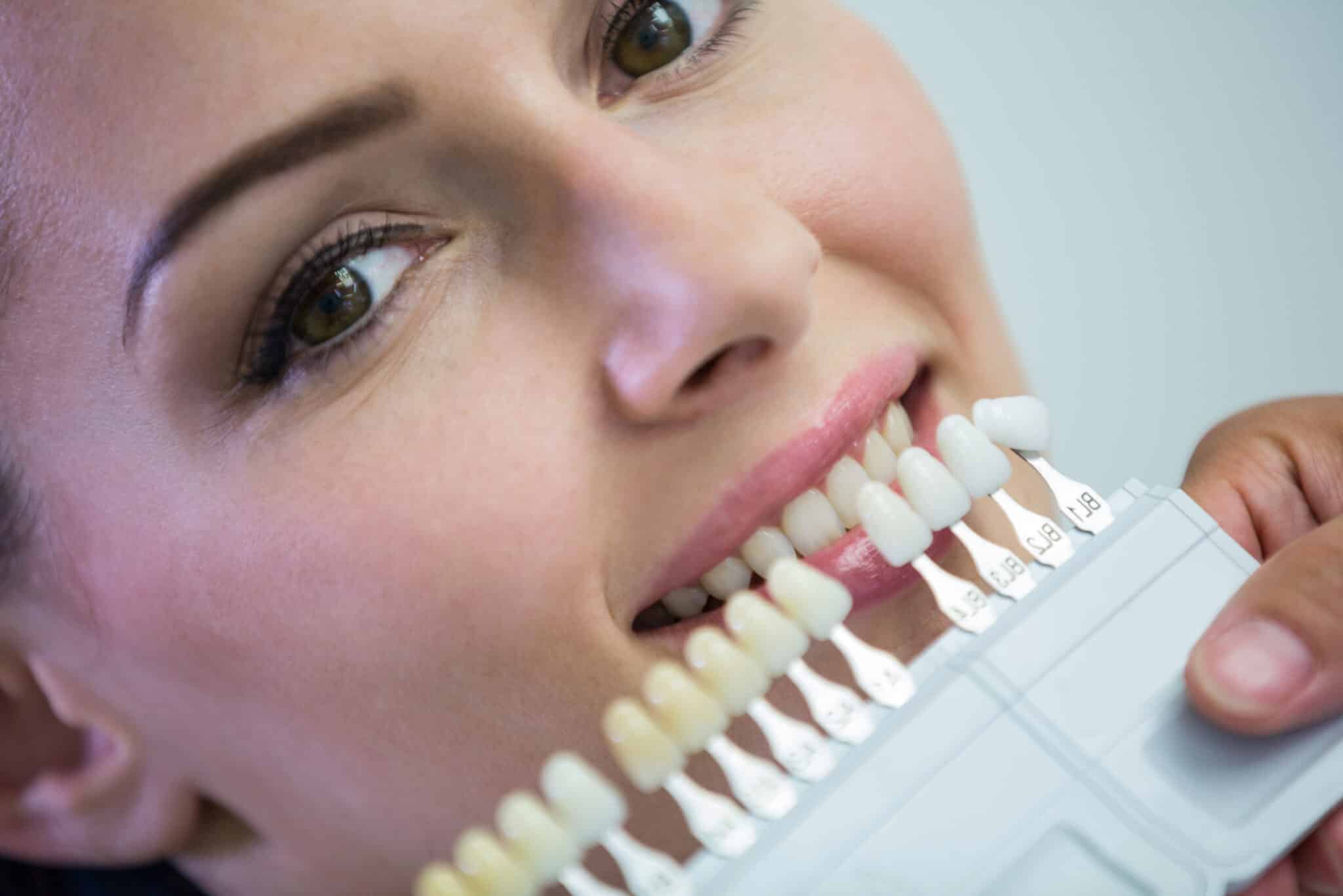 Explaining dental veneers to a young woman